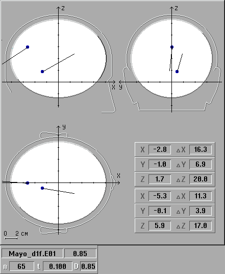 Локализация источников вспышечных ЗВП в норме: ортогональные проекции