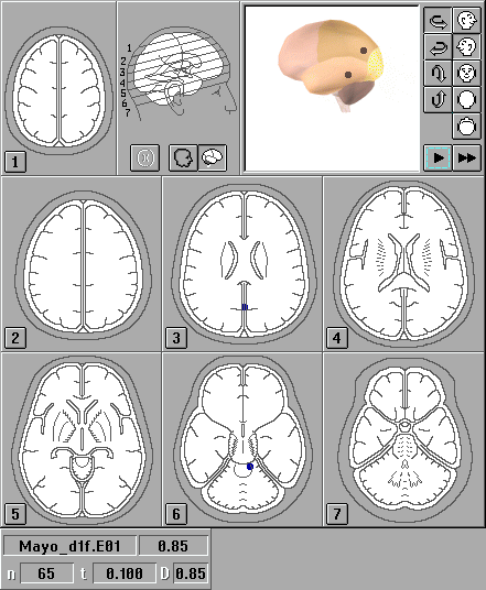 Локализация источников вспышечных ЗВП в норме: послойные изображения