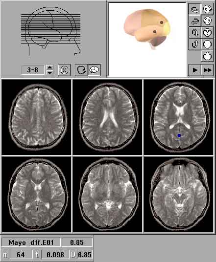 Локализация источников вспышечных ЗВП в норме: МР-томографические изображения