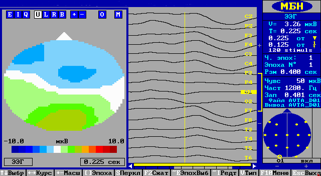 Ретробульбарный неврит OD