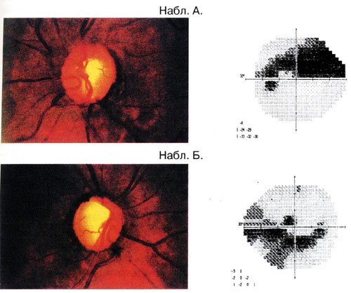 Волков - Рис.4. Клинические примеры соответствия глаукоматозных изменений в ДЗН и нарушений в ЦПЗ при разных типах экскавации.