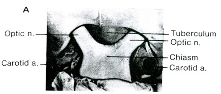 Волков - Рис.7. Анатомический препарат, позволяющий видеть места выхода в полость черепа обоих зрительных нервов