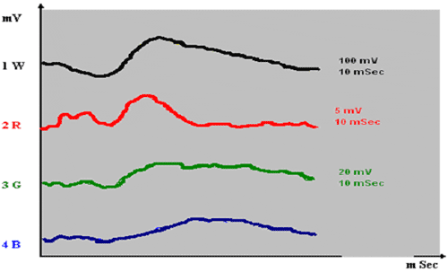 Шамшинова Рис. 3. Максимальная и макулярная ЭРГ у больных глаукомой