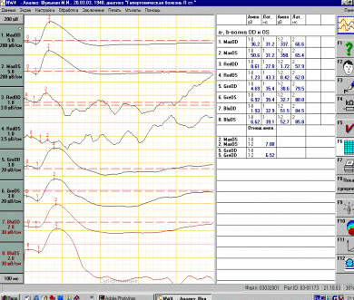 Шамшинова Рис. 5. Максимальная и макулярная ЭРГ у больных с ретинопатией при артериальной гипертензии.