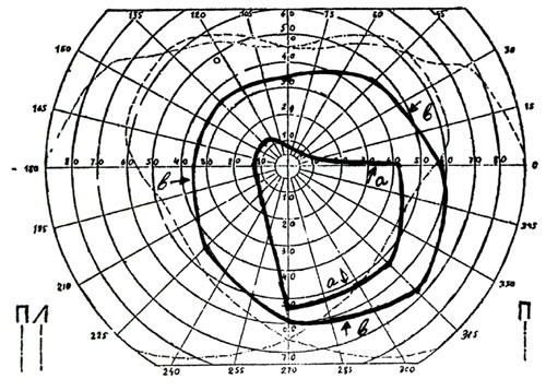 Больная Х. В. И., 62 года. ПЗ правого глаза: а - до лечения, b - после лечения
