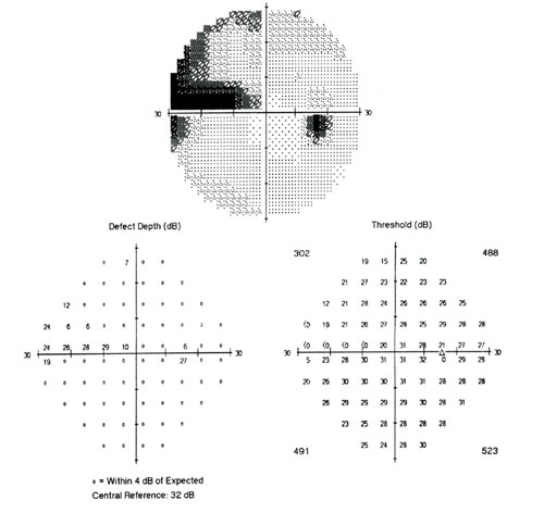 Больной Т. П. И., 52 года. ЦПЗ правого глаза через 2 мес. после лече-ния