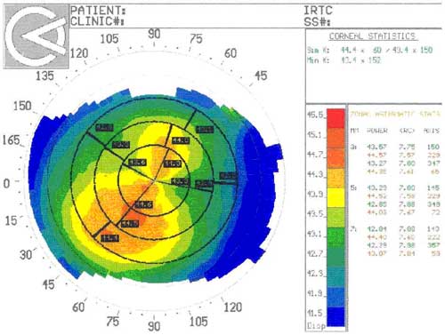 до антиглаукоматозной операции