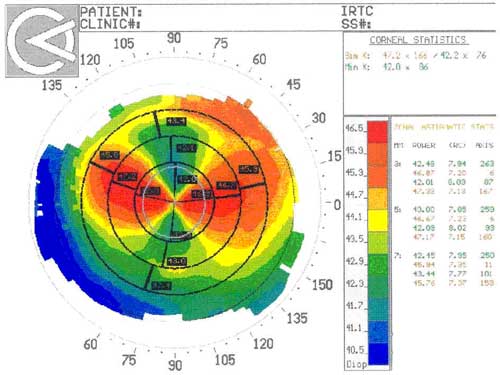 после антиглаукоматозной операции проникающего типа