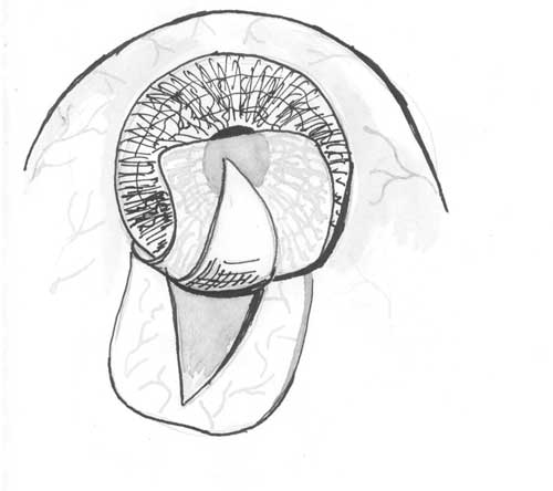Выкраивание наружного склерального лоскута