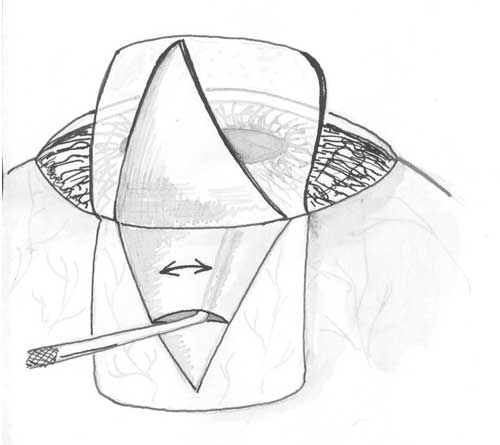 Выполнение циклодиализа через глубокий склеральный разрез