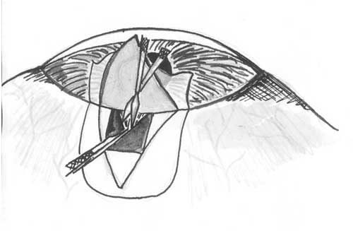 Схема подтягивания радужки в рану и выполнения иридотомии