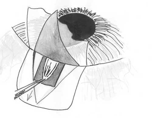 Базальный лоскут радужки с натяжением подтягивается к глубокой склеральной ране