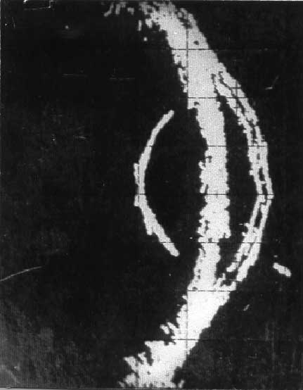 УЗИ - картина до операции