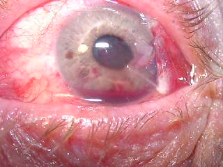 Постконтузионная гифема I cтепени