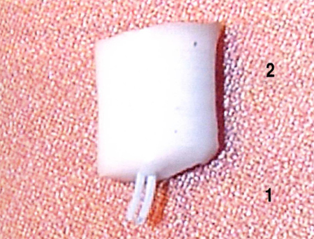 Общий вид дренажа. 1 - микротрубочки, 2 - корпус дренажа.