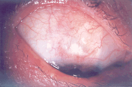Фильтрационная подушка через 3 мес. после реоперации