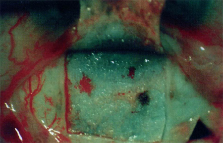 Отсепаровка склерального лоскута