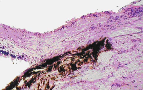 Экспериментальная глаукома. Выраженная атрофия слоя аксонов ганглиозных клеток сетчатки кроликов у диска зрительного нерва. Окраска гематоксилином и эозином. Ув.  200