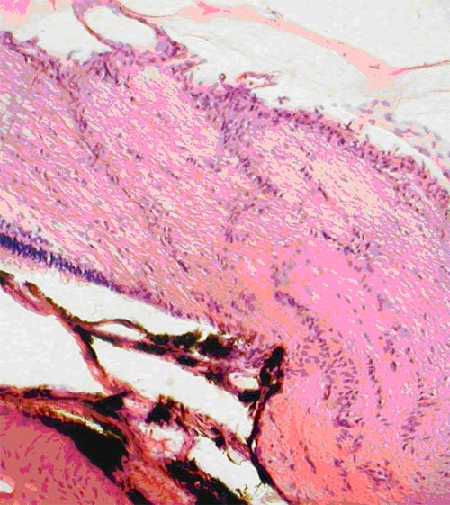 Экспериментальная глаукома, леченная препаратами эрисод и бетоптик С. Незначительное проявление атрофии аксонов ганглиозных клеток сетчатки кроликов вблизи диска зрительного нерва. Окраска гематоксилином и эозином. Ув.  200